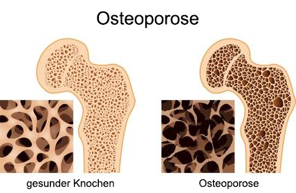 Osteoporose - gesunder Knochen, kranker Knochen